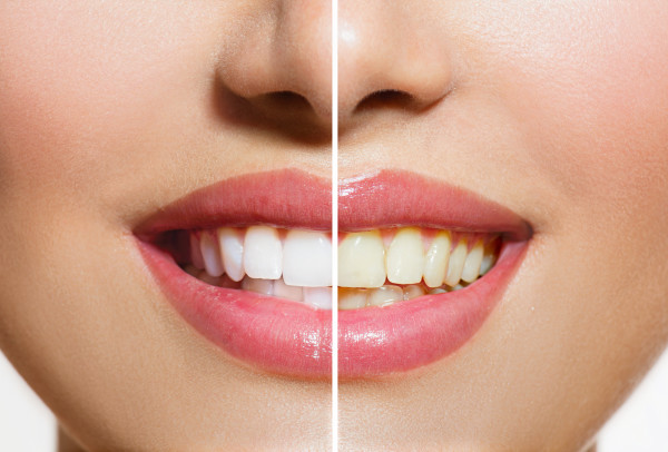 Woman Teeth Before and After Whitening.